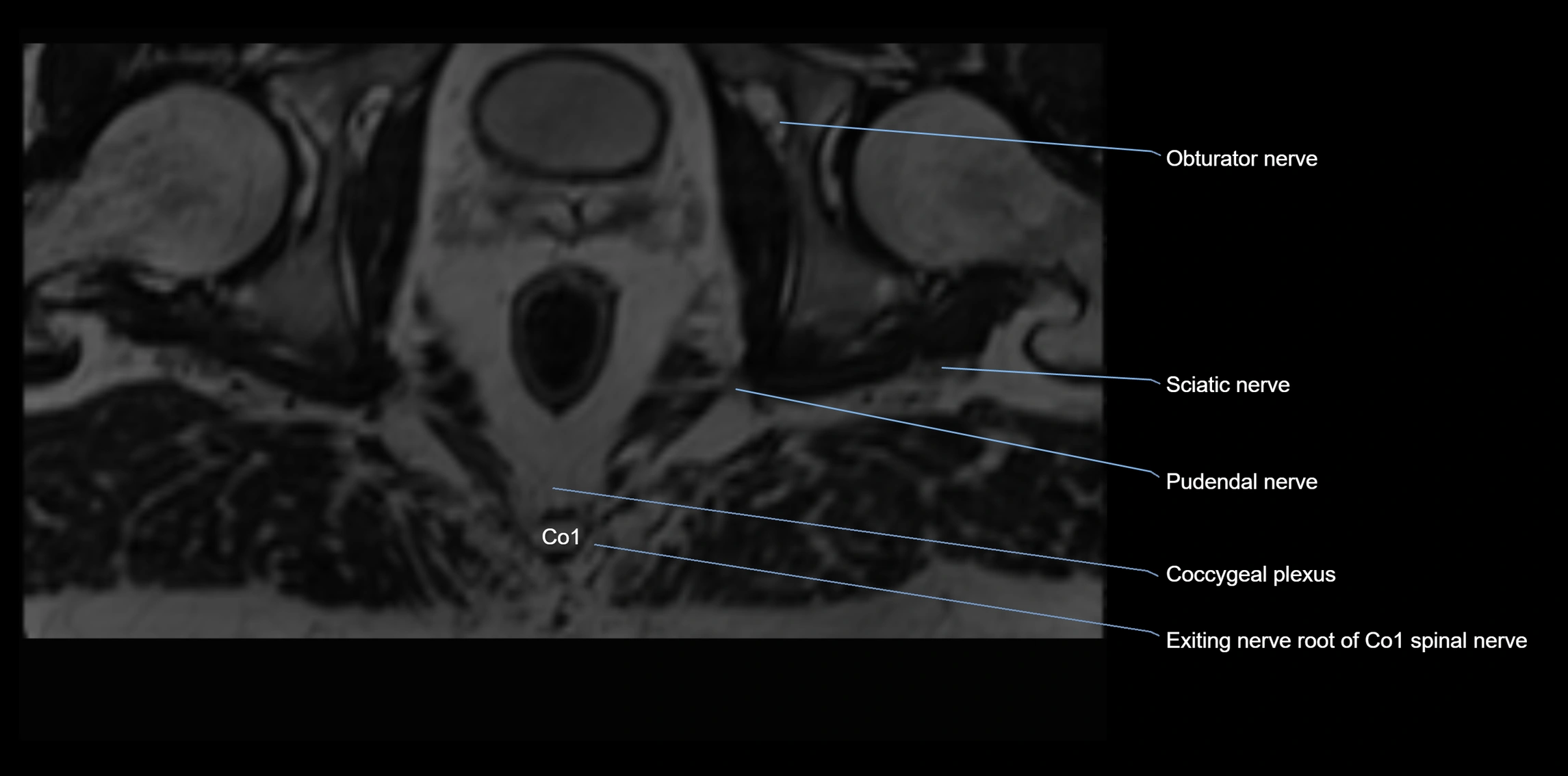 MR lumbosacral plexus axial cross sectional anatomy 3T  radiology  image-img-1008001-00128.webp